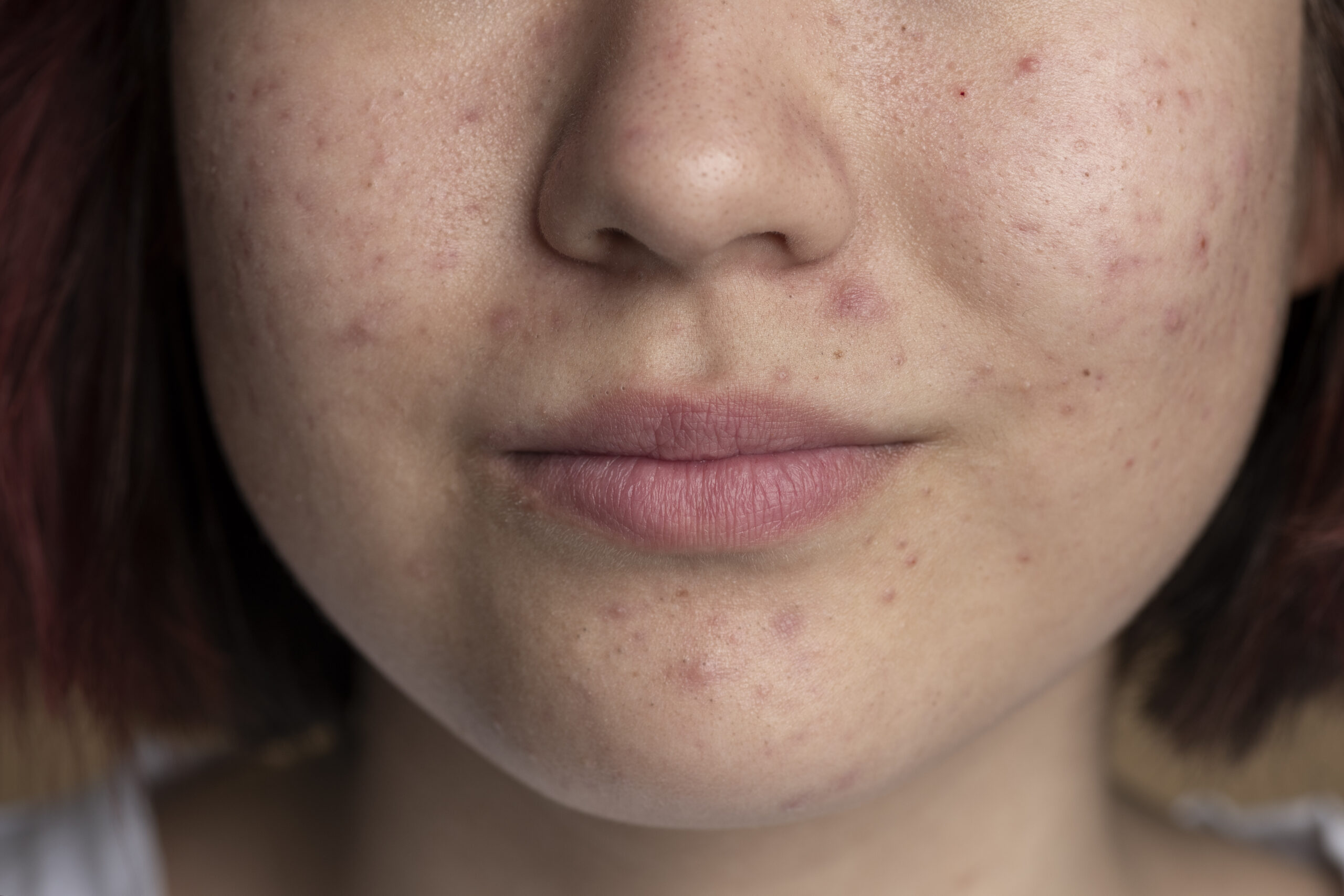 Perawatan kulit wajah dengan kandungan skincare untuk jerawat